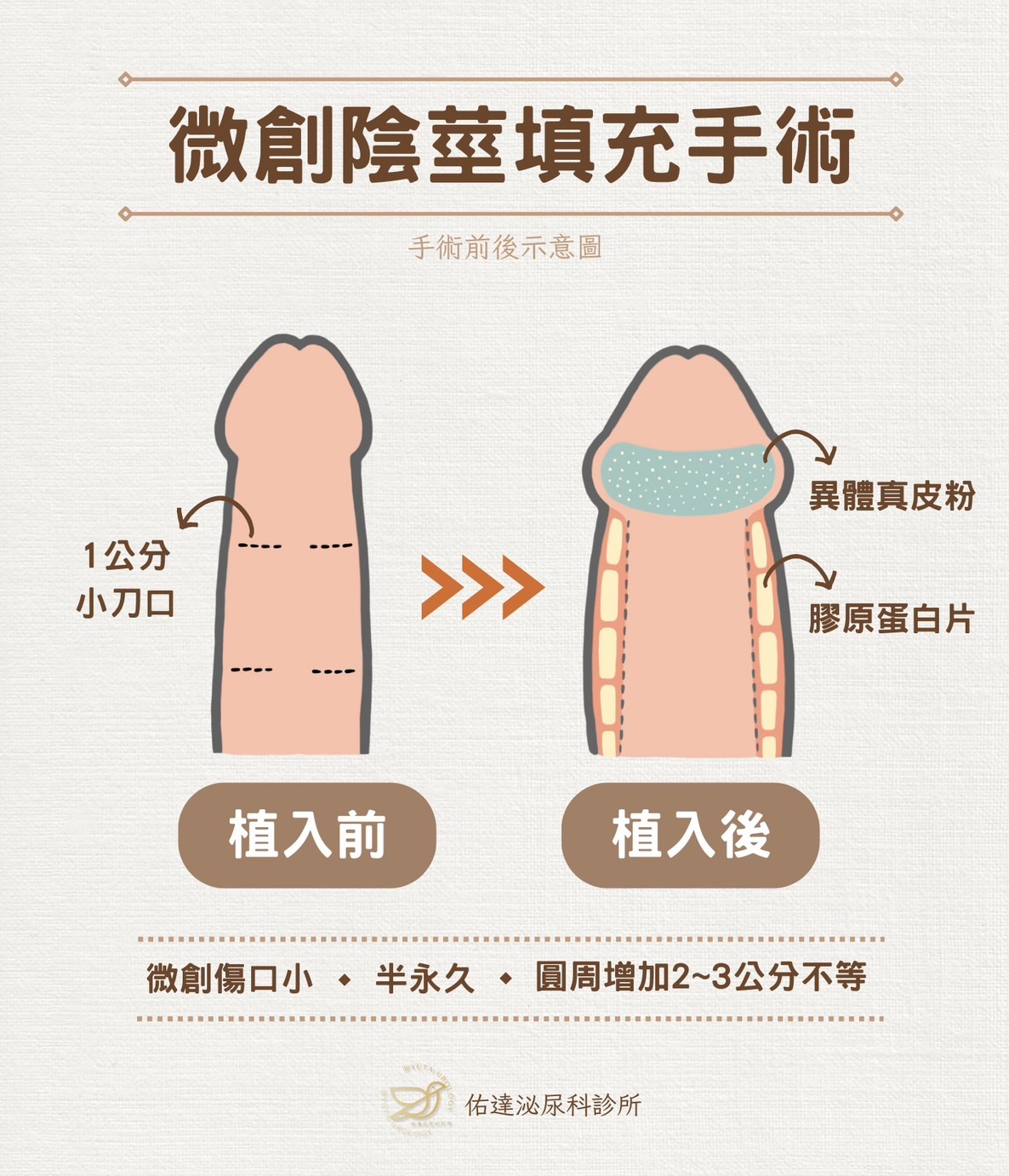 陰莖增大術與包皮手術搭配說明