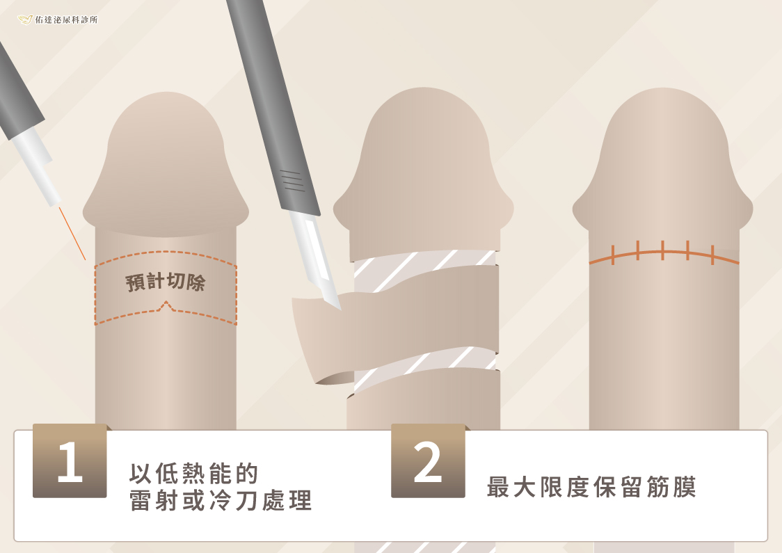 精緻雷射/冷刀環切:低熱能切除,保留筋膜