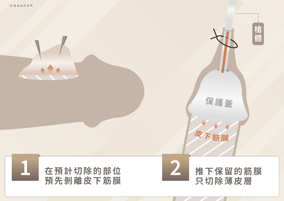 微創筋膜保留包皮槍:先剝離皮下筋膜,只切除薄皮層