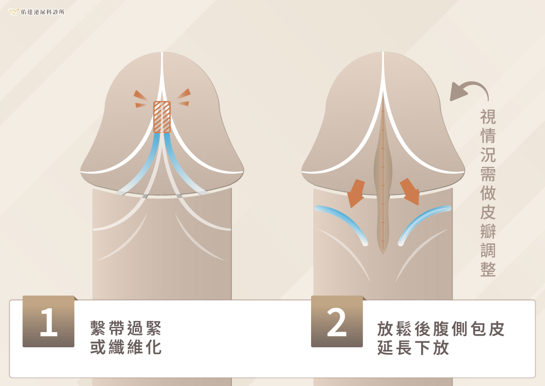 包皮繫帶手術方式:過緊的繫帶放鬆後,調整皮瓣、修葺平整再縫合
