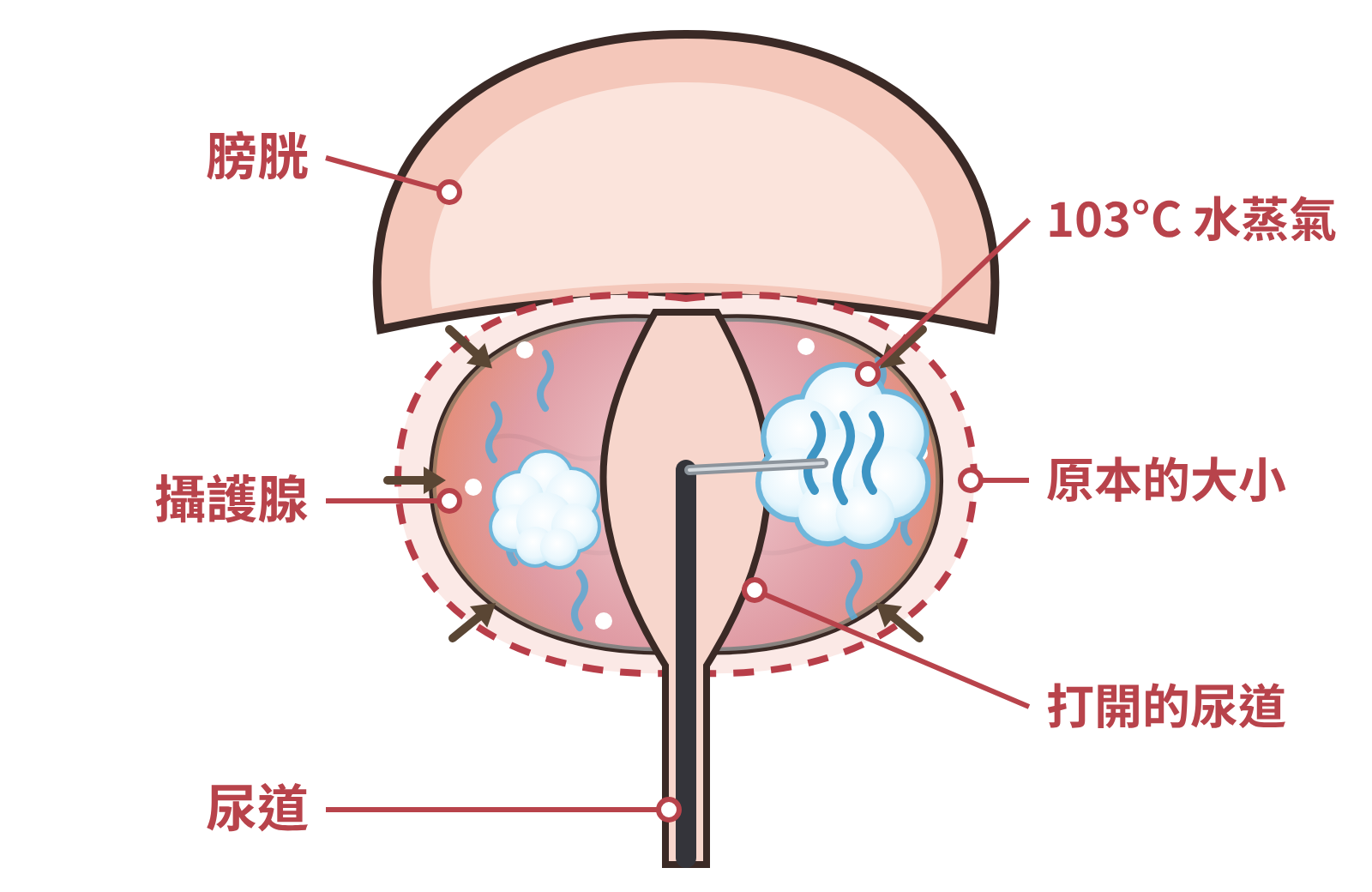 水蒸氣消融示意圖:細針把 103°C 水蒸氣打進攝護腺,組織縮小、尿道打開