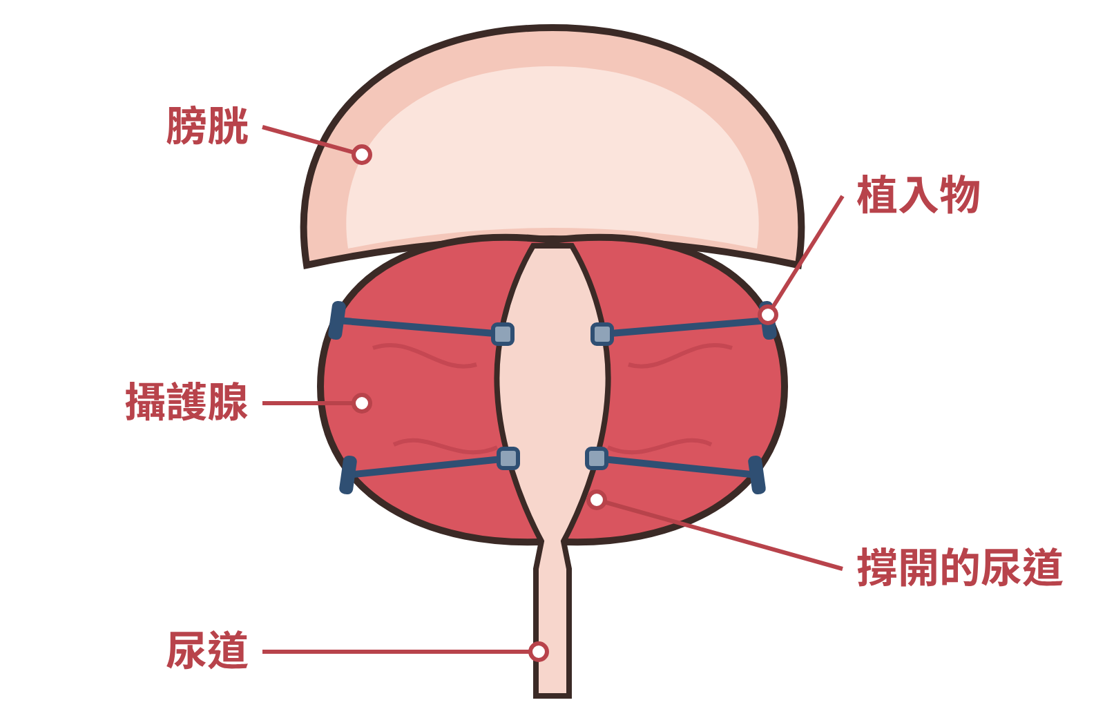 攝護腺拉提術示意圖:植入物把兩側攝護腺往外拉,撐開尿道