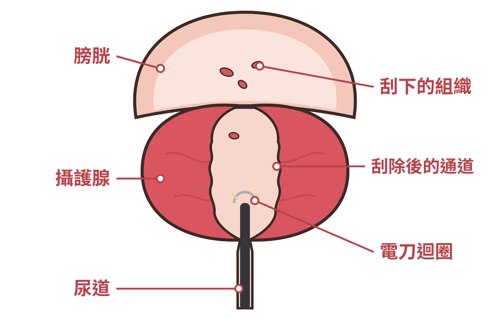 電刀刮除示意圖:電刀迴圈刮除肥大組織,留下較寬的通道