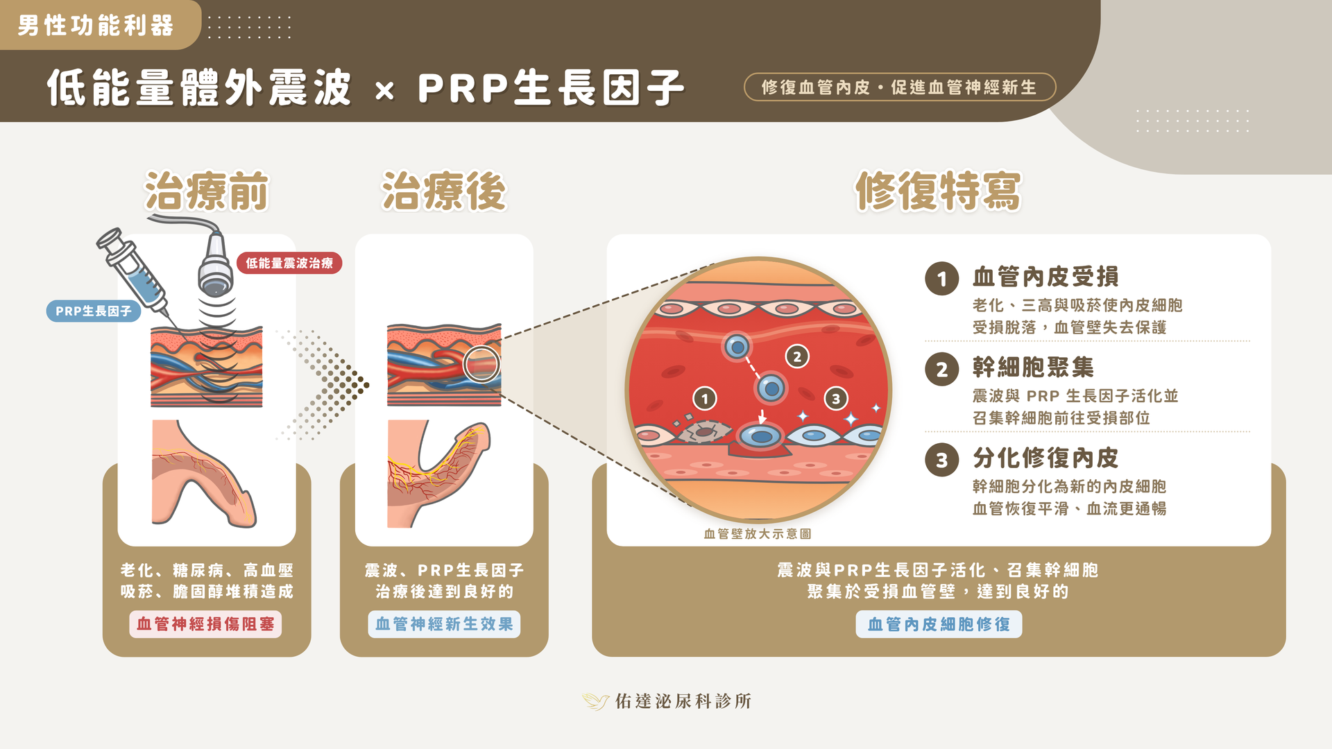 陰莖血流 · 生長因子的加乘：合併低能量震波與 PRP，6 次震波療程中 PRP 於第 2、4、6 次同日施打