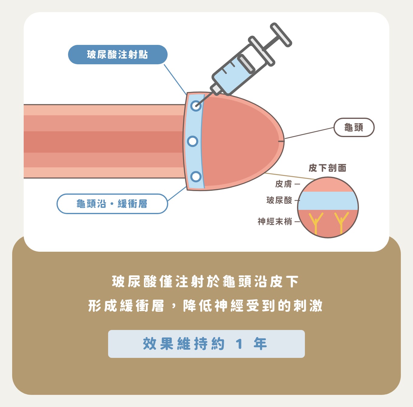 龜頭玻尿酸注射示意圖:玻尿酸注射於龜頭沿皮下形成緩衝層,降低神經受到的刺激