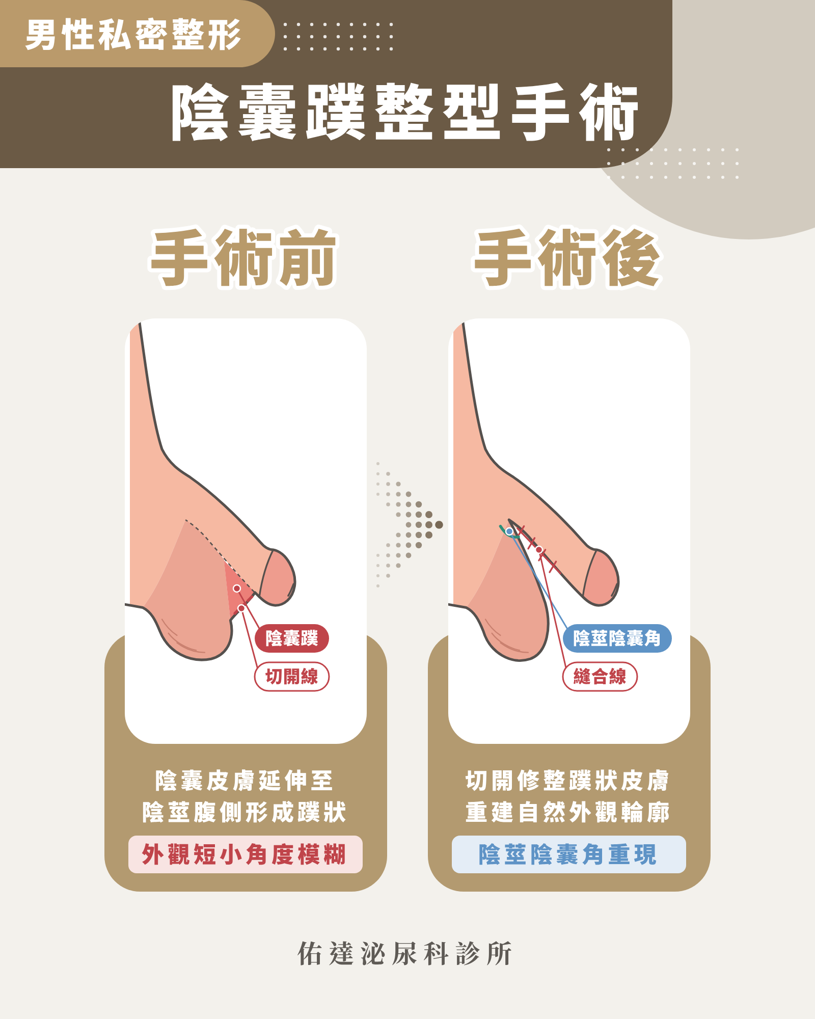 陰囊蹼整型手術前後示意圖:切開並修整蹼狀皮膚後陰莖陰囊角重現