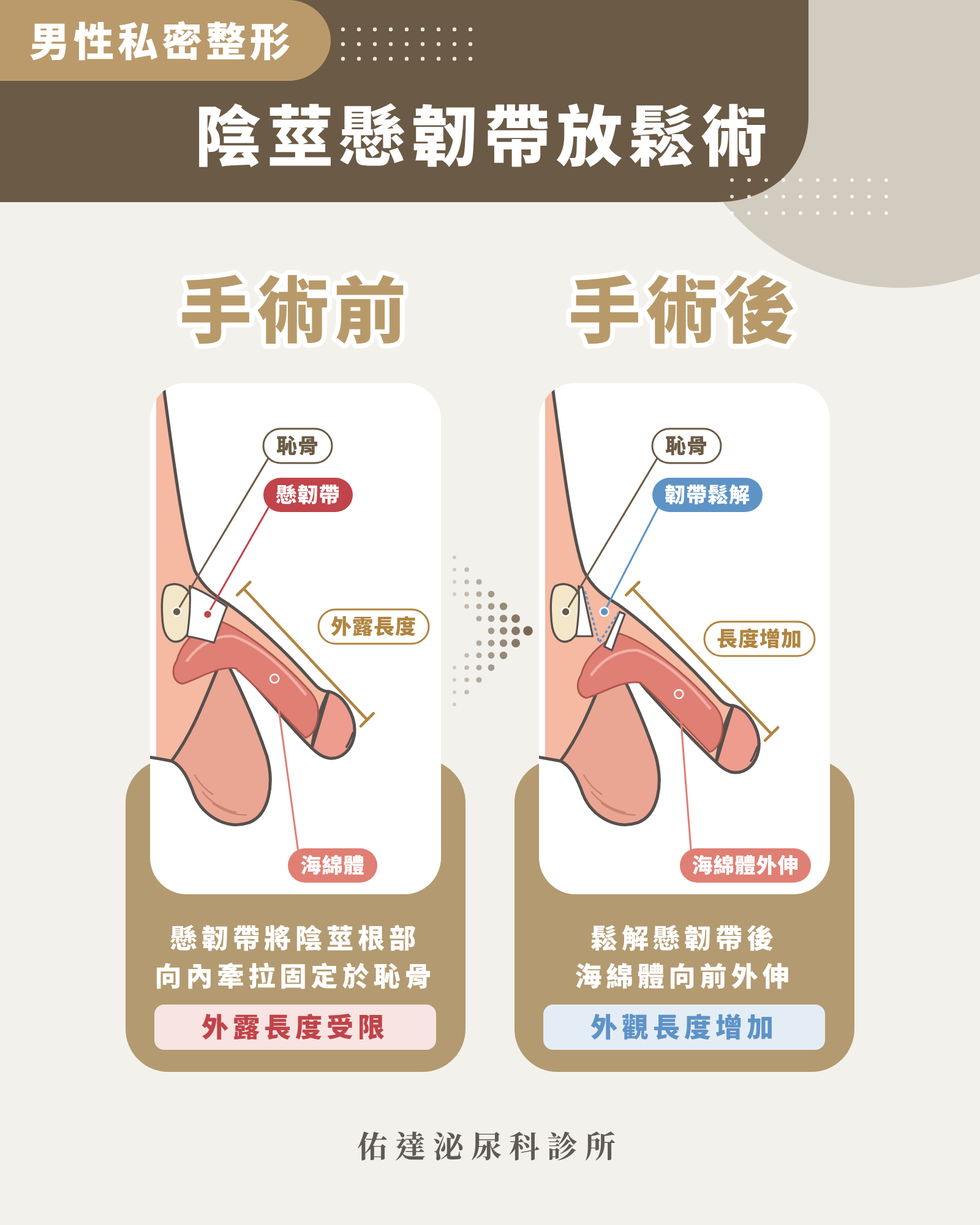 懸韌帶放鬆手術前後示意圖:鬆解懸韌帶後海綿體向前外伸,外觀長度增加