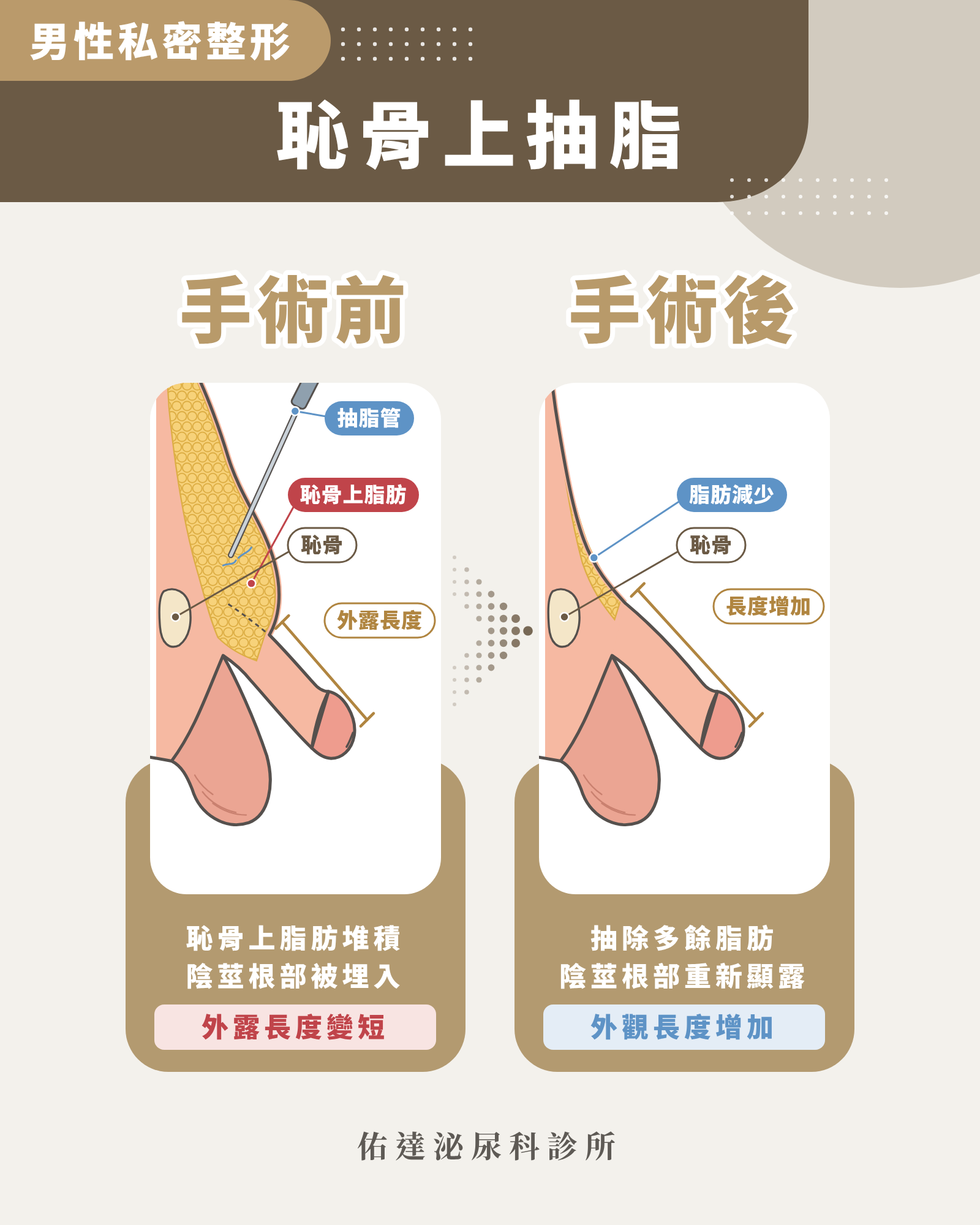 恥骨上抽脂手術前後示意圖:抽除恥骨上脂肪後陰莖根部重新顯露
