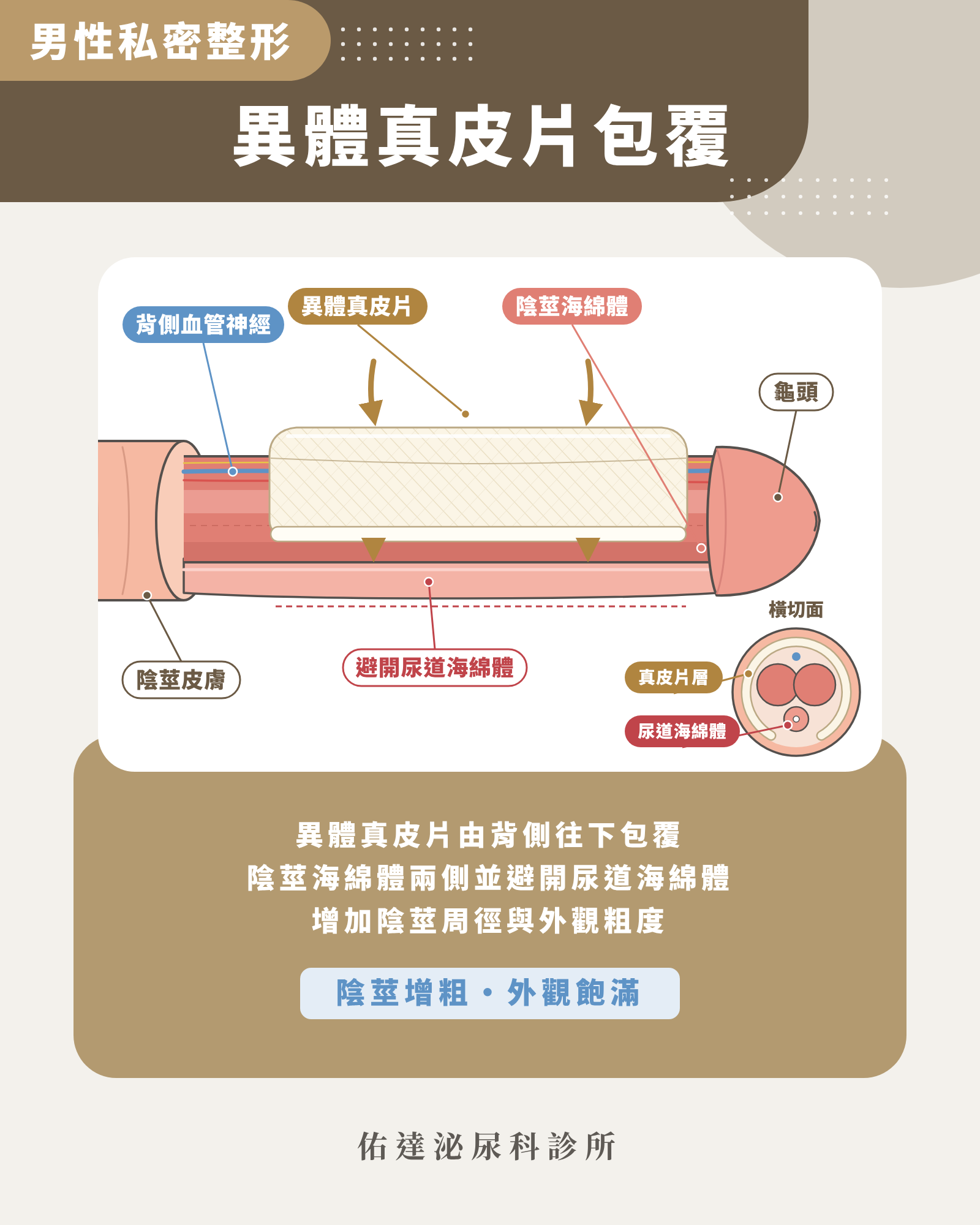 異體真皮增大示意圖:異體真皮片由背側往下包覆陰莖海綿體兩側並避開尿道海綿體