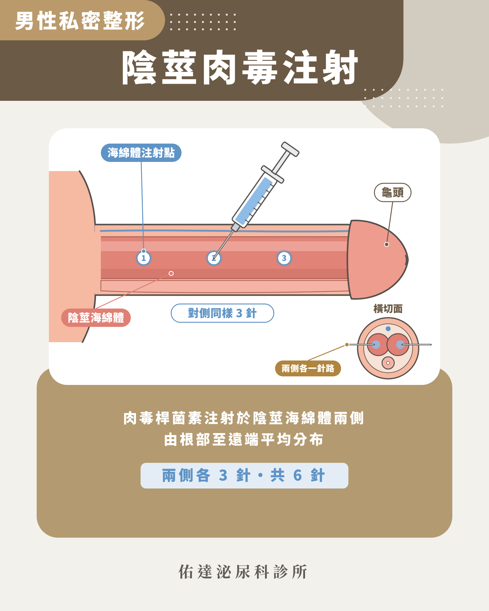 肉毒陰莖注射位置示意圖:肉毒桿菌素注射於陰莖海綿體兩側,兩側各 3 針共 6 針