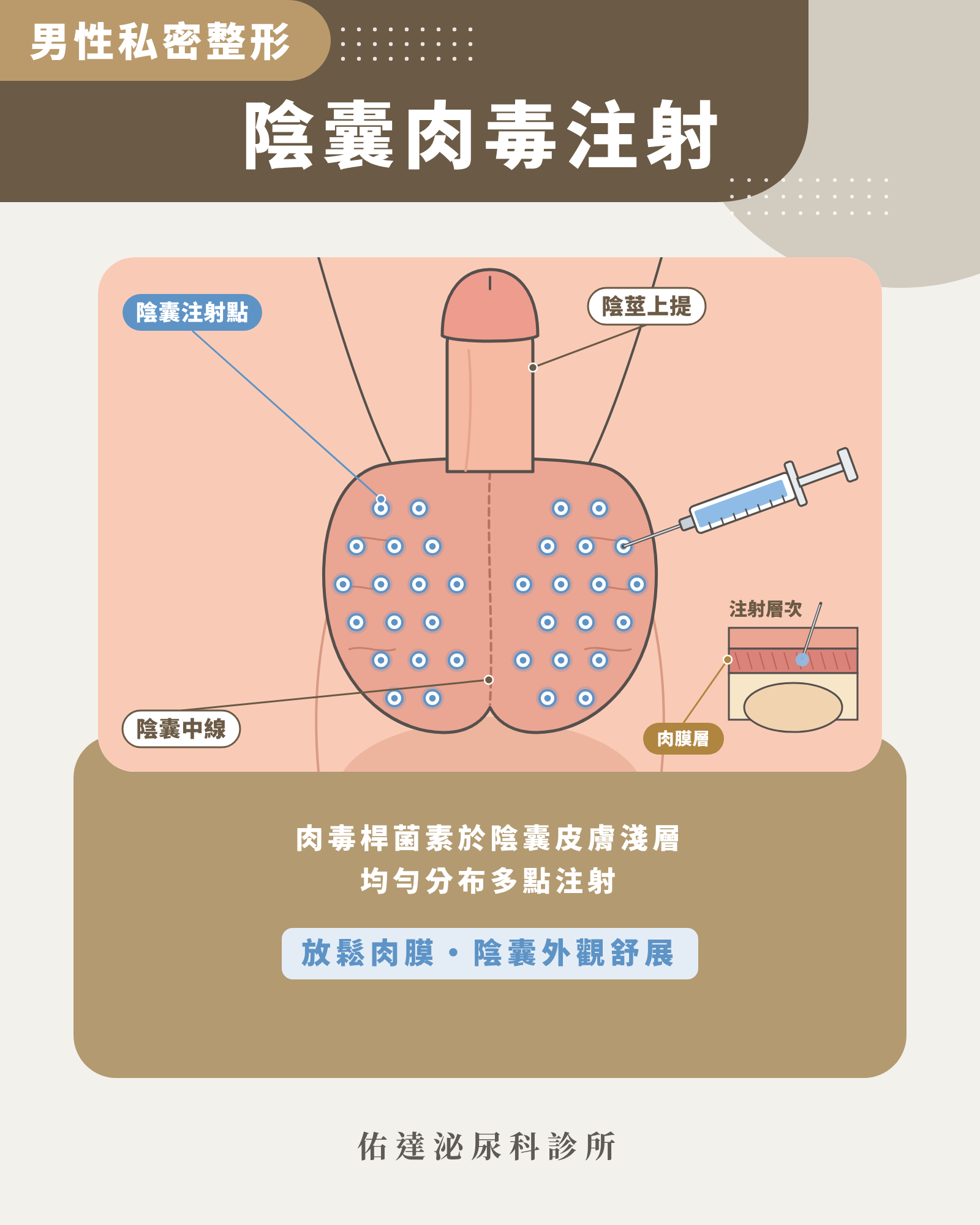 肉毒陰囊注射位置示意圖:肉毒桿菌素於陰囊皮膚淺層肉膜層均勻多點注射