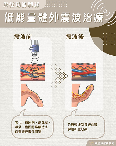 低能量體外震波治療前後示意：老化、糖尿病、高血壓、吸菸與膽固醇造成血管神經損傷阻塞，治療後血管神經新生